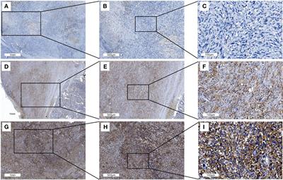 FGF-Receptors and PD-L1 in Anaplastic and Poorly Differentiated Thyroid Cancer: Evaluation of the Preclinical Rationale